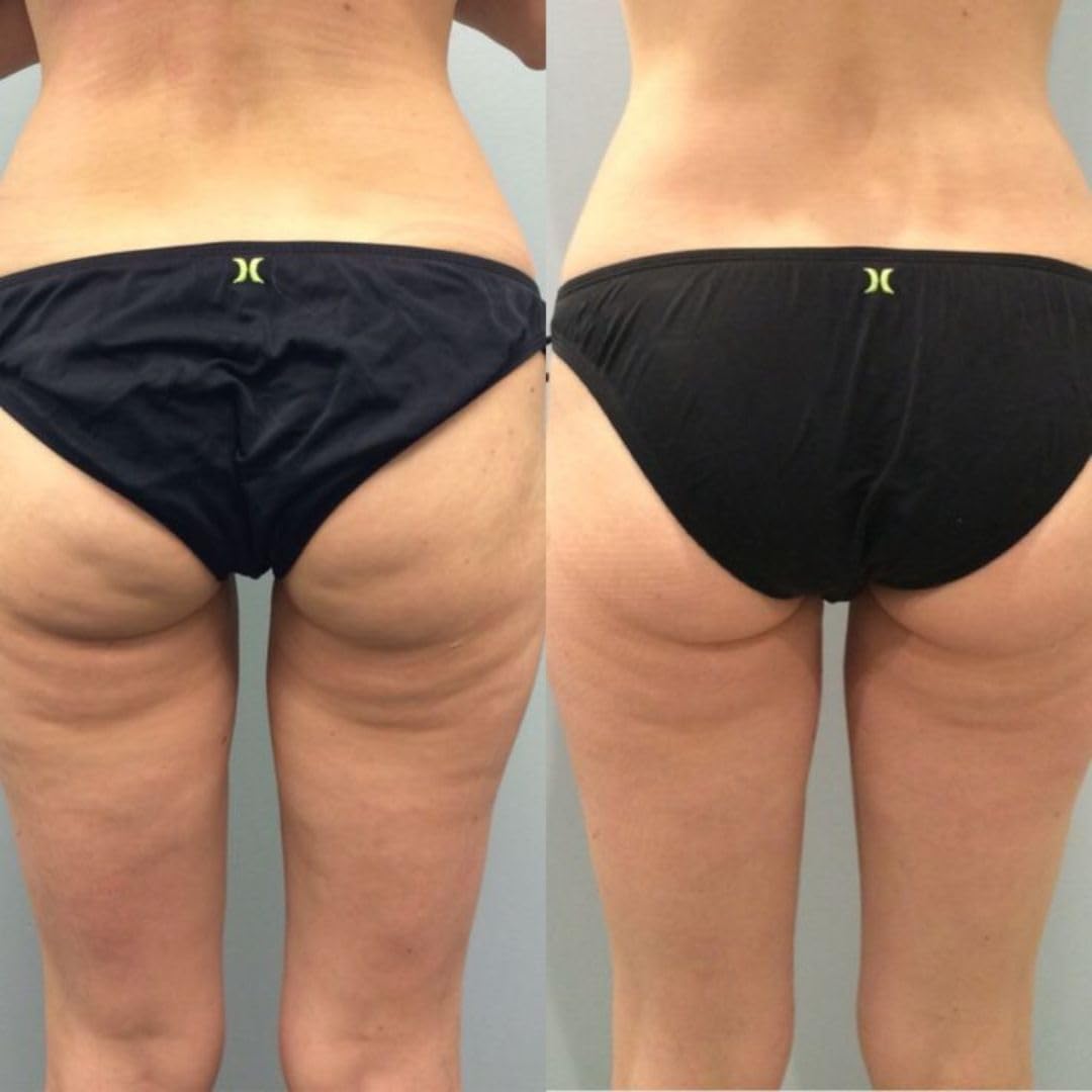 Bum bum Cream – Firming & Lifting Body Cream for Cellulite and Stretch Marks – With Natural Brazilian Extracts – 8oz – Smooth, Hydrate & Tighten Skin – All Skin Types