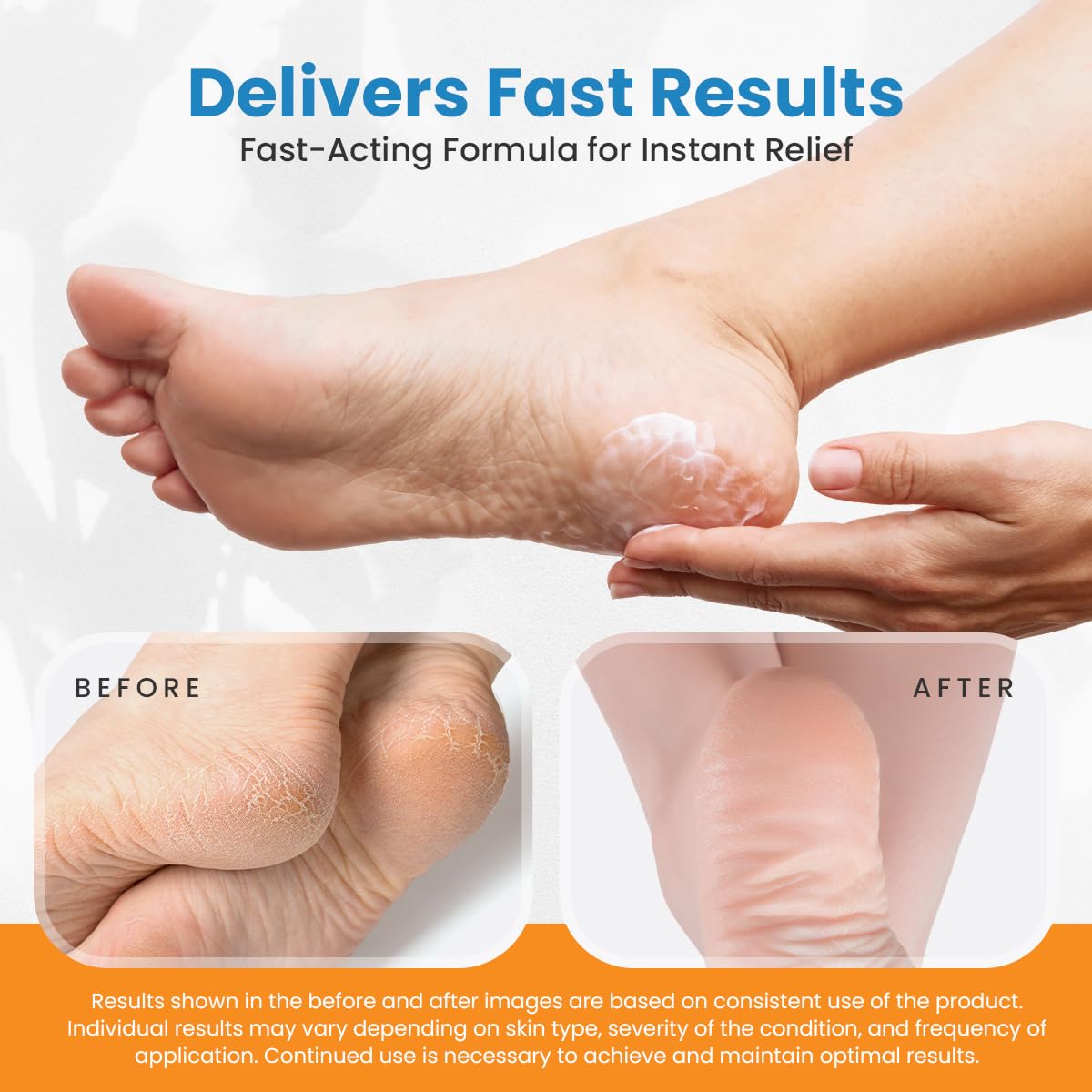 Revitaderm 4D Urea Cream 40% for Feet, Intensive Moisturizing Foot Cream for Dry, Rough, Callused Skin, Includes Free Pumice Stone and Exfoliating Brush, Fast-Absorbing, Fragrance-Free, 4oz, 5 Pack