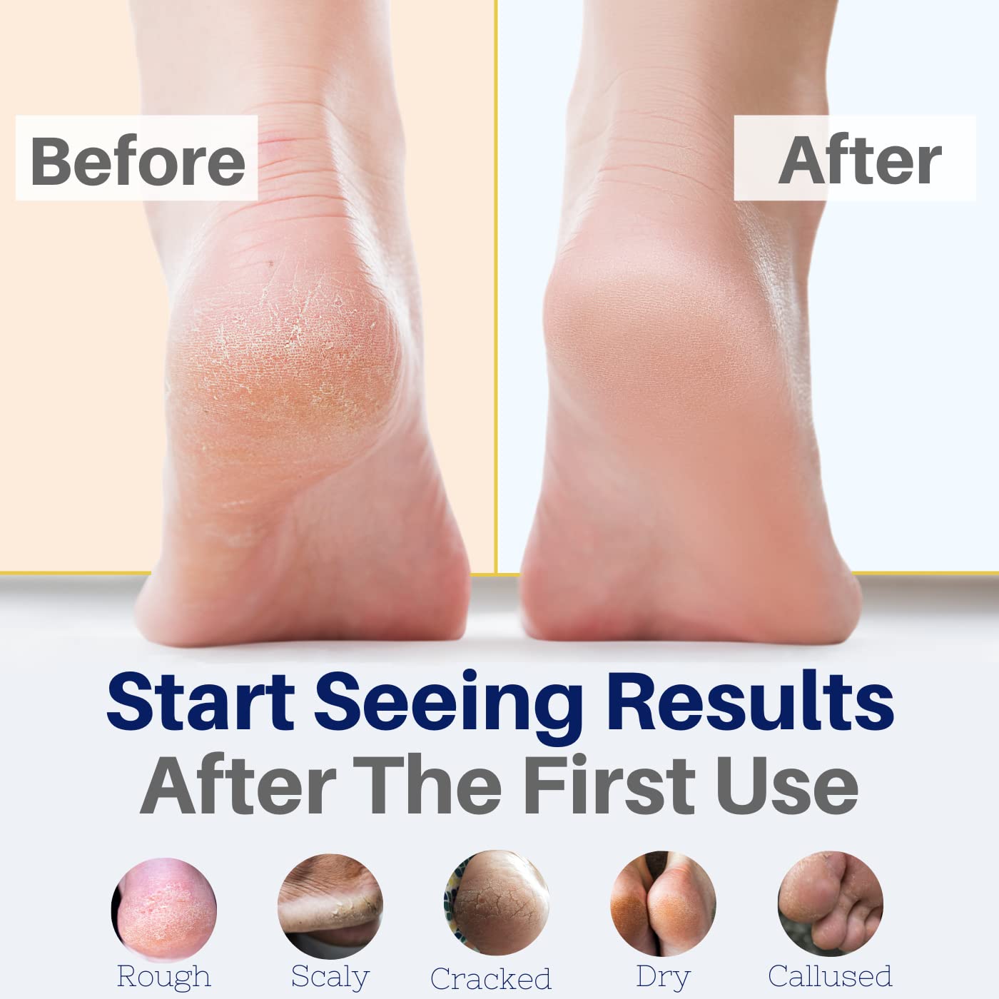 Yellow Bird Foot Cream – Hydrating Tea Tree Oil Foot Balm with Essential Oils. Natural Athletes Foot Treatment. Moisturizing Cracked Feet Repair & Callus Remover. Made In USA - 2 oz