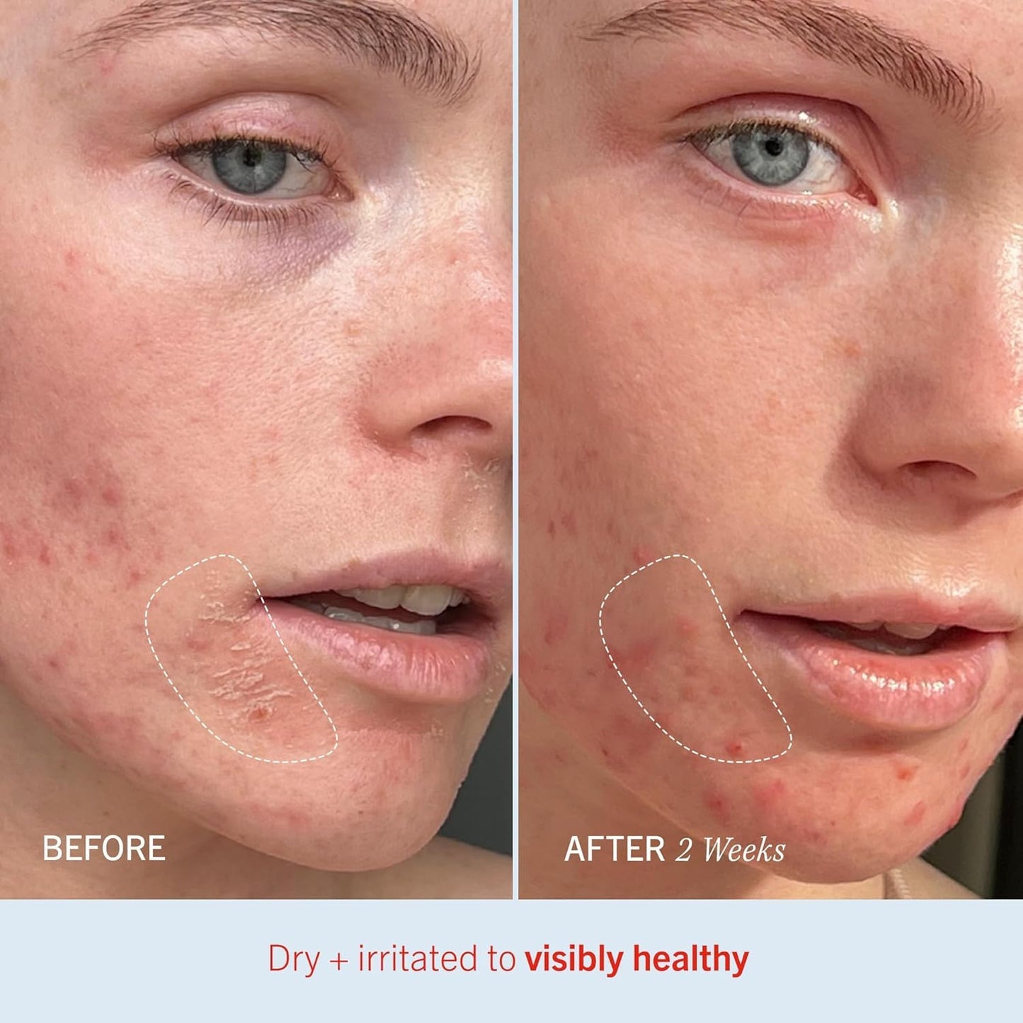 First Aid Beauty - Ultra Repair Cream, Intense Hydration Whipped Colloidal Oatmeal, Clinically Proven to Strengthen Skin Barrier & Help Relieve Eczema, Face & Body Moisturizer, 14oz Peppermint Twist