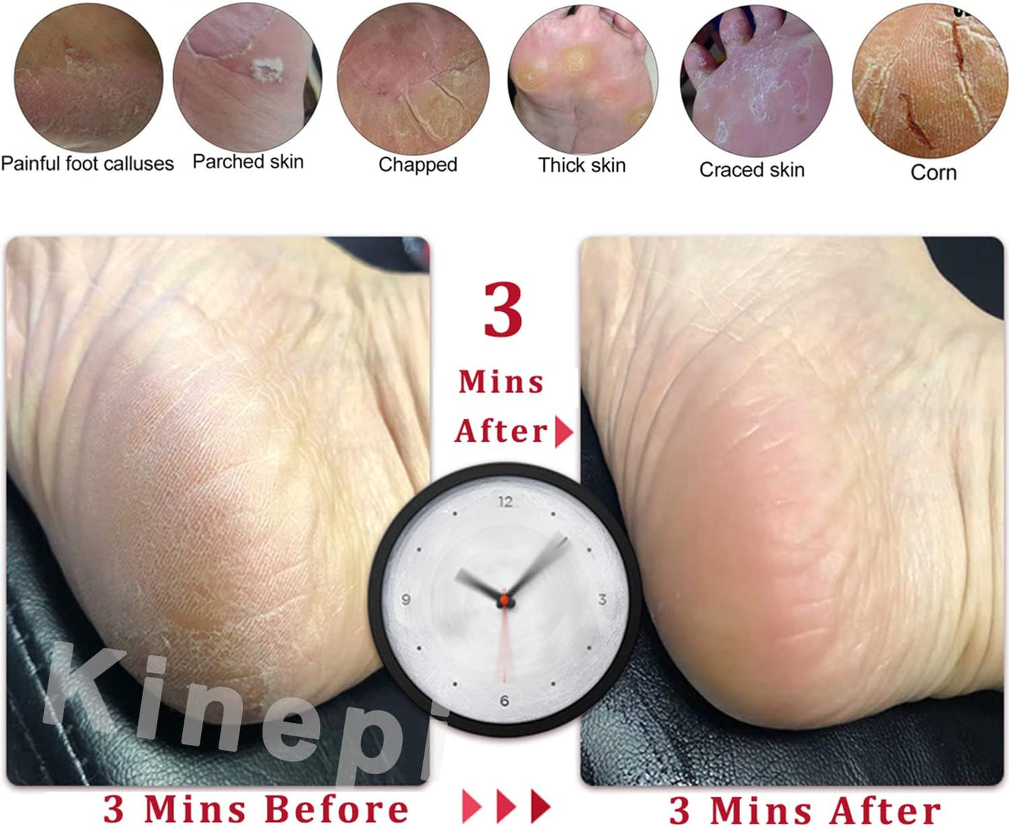 Callus Remover Foot Scrubber Colossal Foot File Foot Care and Foot Exfoliator Foot Rasp Pedicure Tools Pumice Stone for Feet,Remove Corn Hard Skin Dead Skin for Use in Shower Foot Scraper Kit