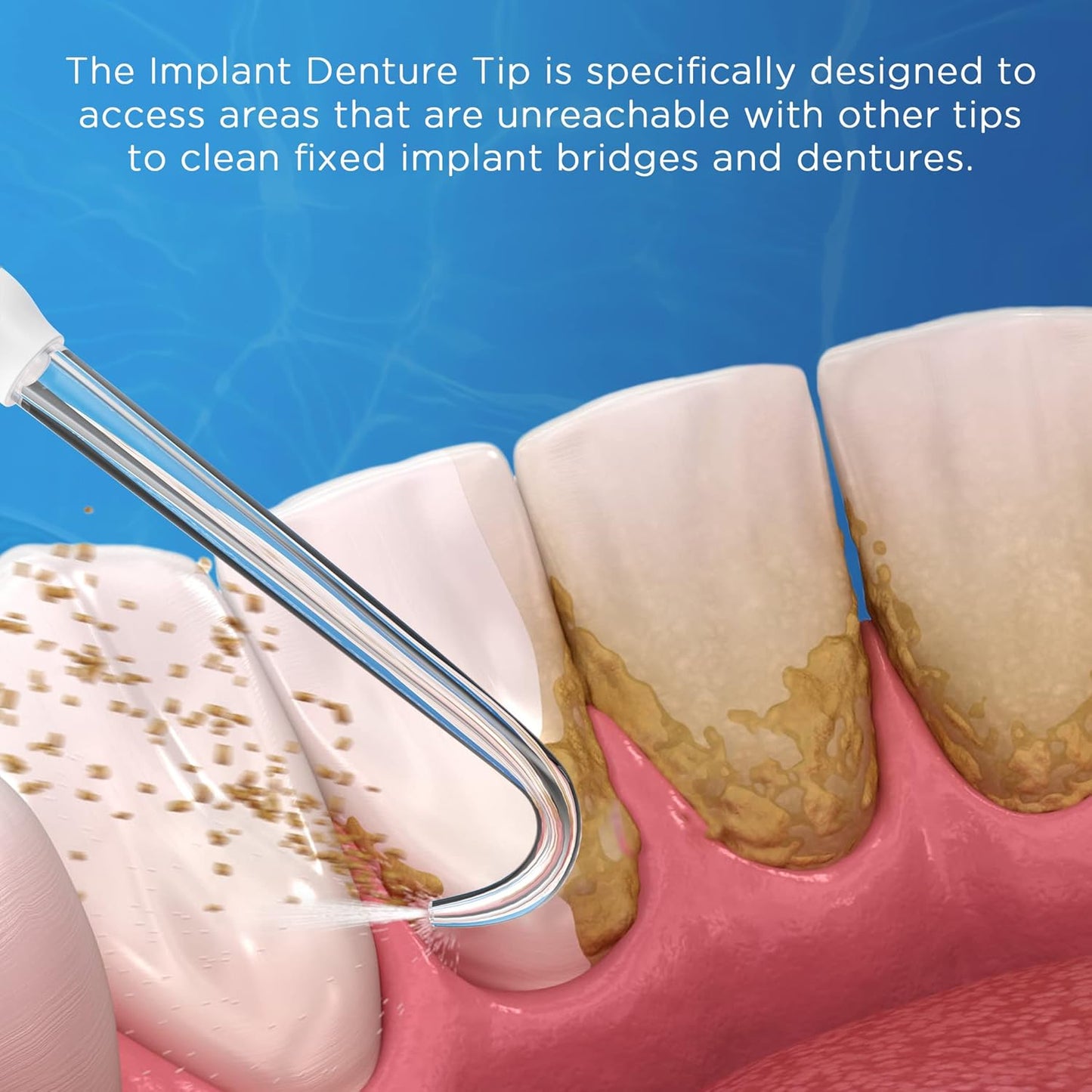 Replacement Tips for Waterpik Water Flosser (6 Implant Denture Tips)