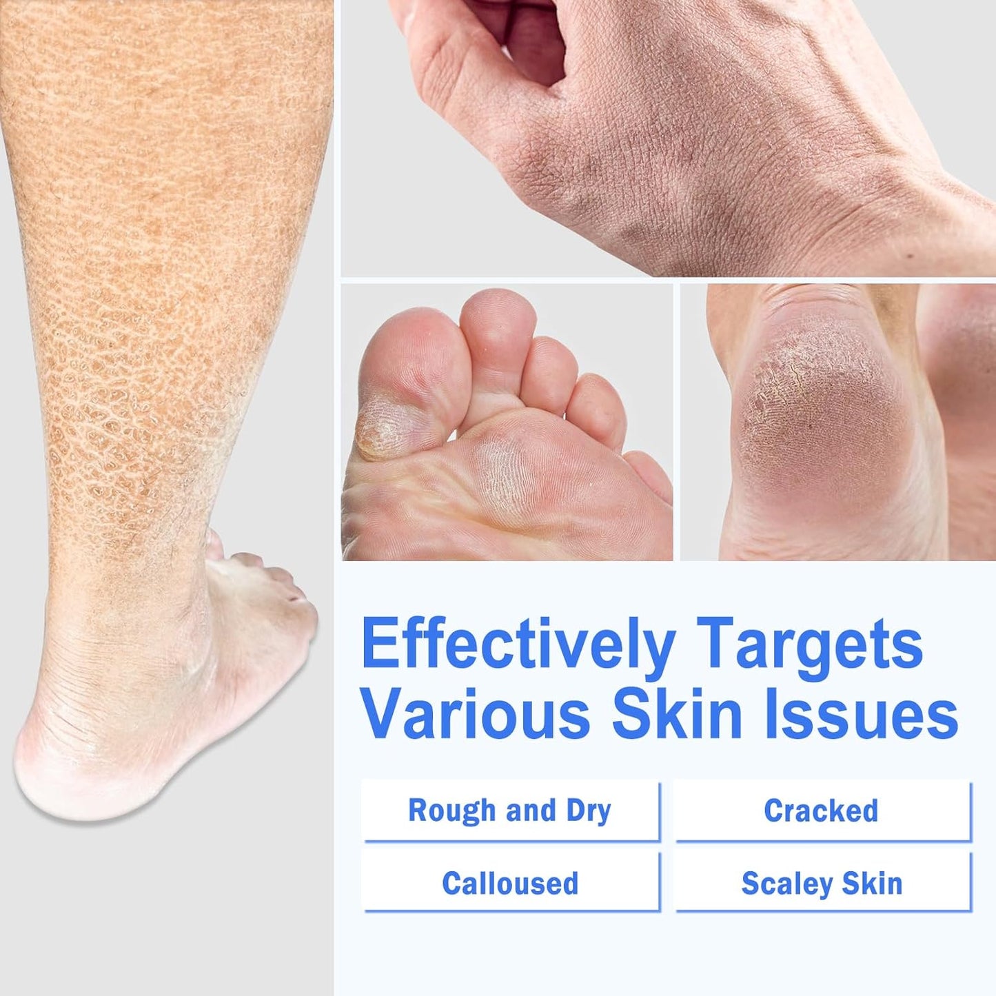 Ultra-Hydrating Foot Cream for Dry Cracked Heels and Feet, Pair with Silicone Socks for Cracked Heel Treatment, Silicone Socks Included (Urea Conc. 40.67%, 5.29 OZ/150g)