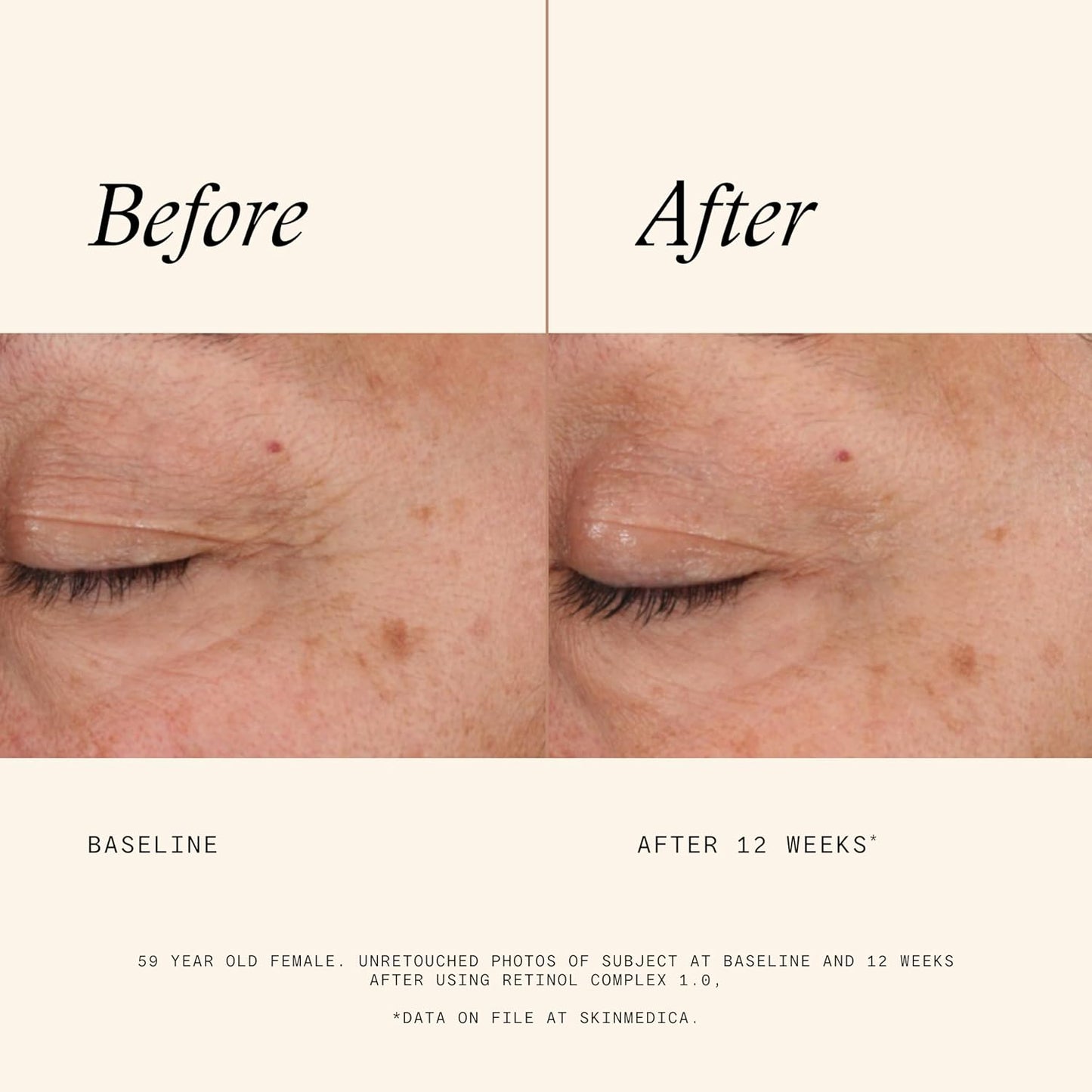 SkinMedica Retinol 1.0 Complex - Retinol Serum for Face, Age-Defying Advanced Retinol Cream That Renews Skin and Diminishes the Appearance of Fine Lines and Wrinkles, 1 Fl Oz