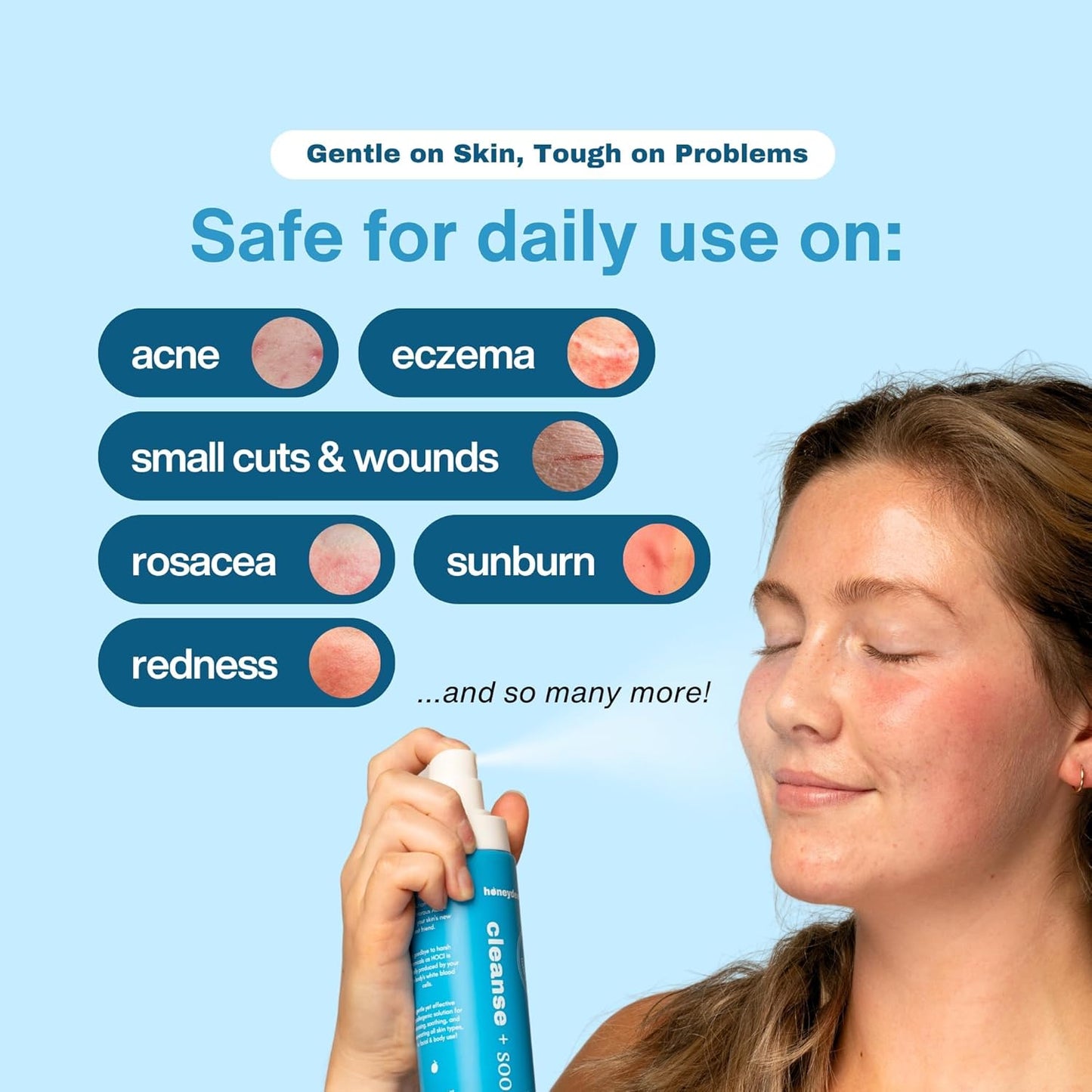 Honeydew Labs Hypochlorous Acid Spray – HOCl Face & Skin Mist for Acne, Eczema & Irritation – Multi-Purpose Skin Repair – Eyelid Cleanser, Post-Workout, Post-Procedure, Scalp & Sensitive Skin – 6.8 oz