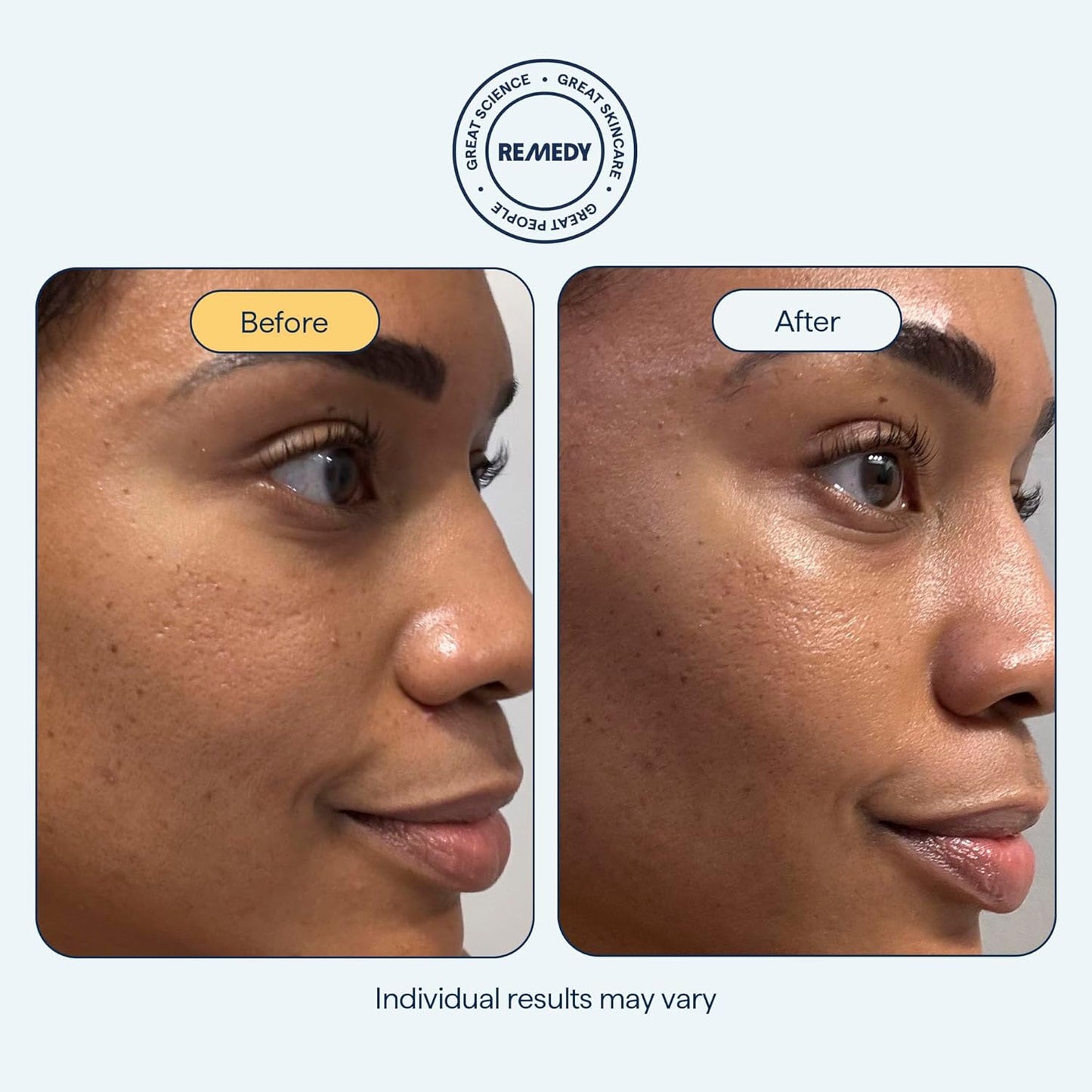 Remedy for Rich Moisture - Barrier Repairing Rich Cream Moisturizer for Normal to Dry Skin - Quadruple Ceramide Complex, Peptides, Squalane, Glycerin- By Dermatologist Dr. Shah, 1.7 fl. oz