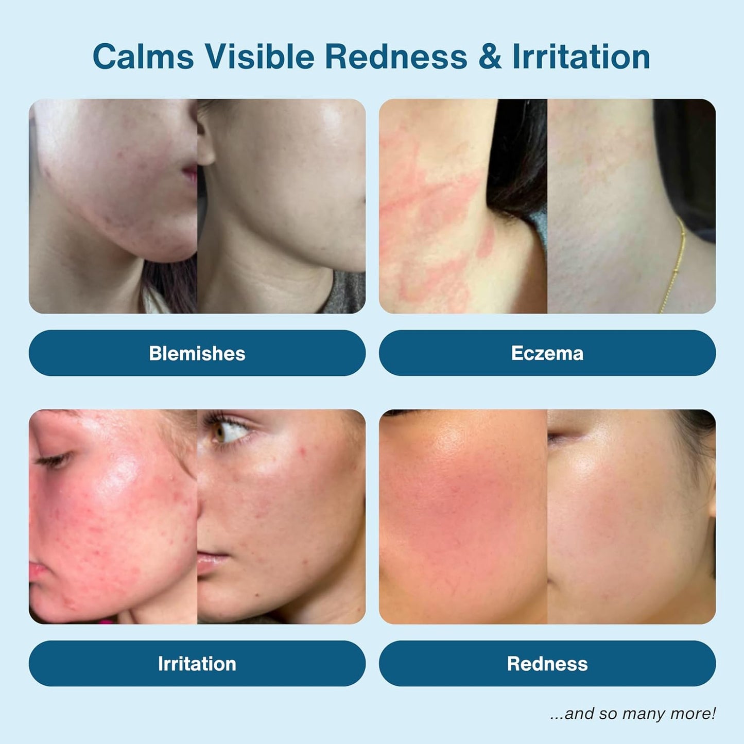 Honeydew Labs Hypochlorous Acid Spray – HOCl Face & Skin Mist for Acne, Eczema & Irritation – Multi-Purpose Skin Repair – Eyelid Cleanser, Post-Workout, Post-Procedure, Scalp & Sensitive Skin – 6.8 oz