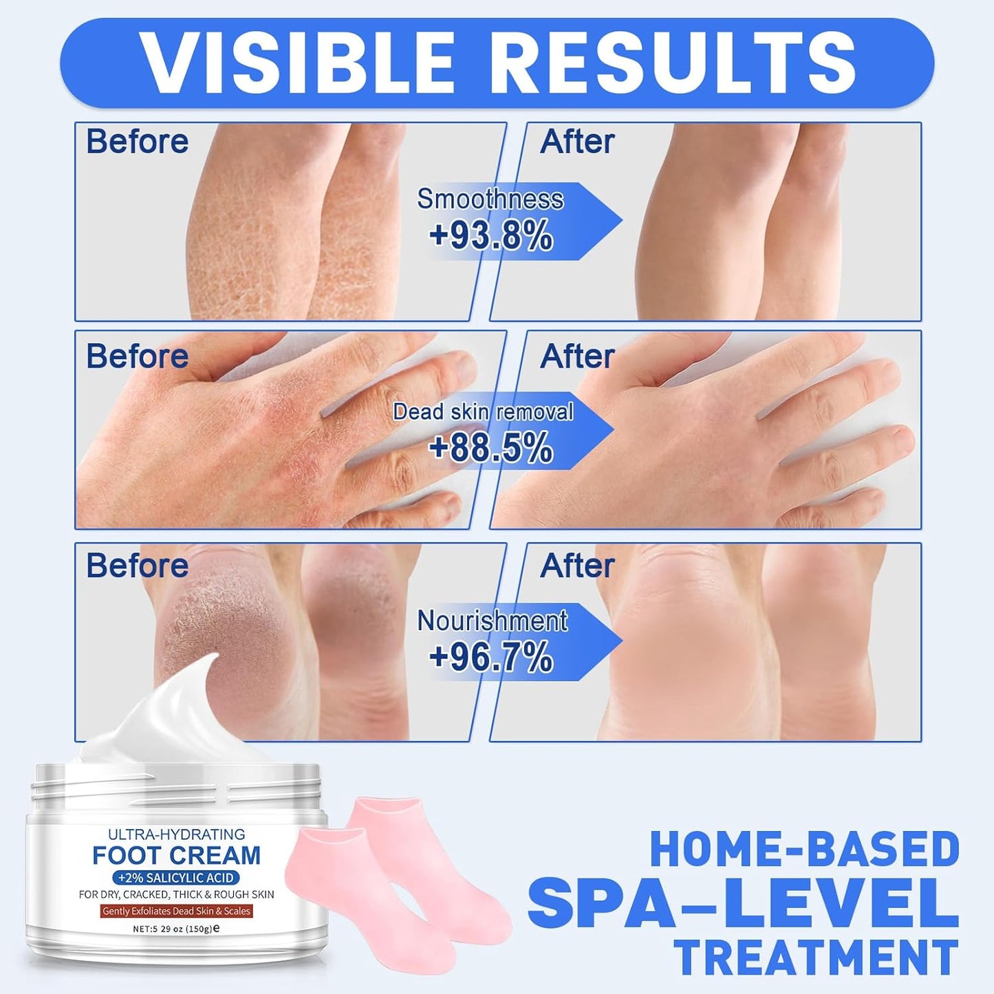 Ultra-Hydrating Foot Cream for Dry Cracked Heels and Feet, Pair with Silicone Socks for Cracked Heel Treatment, Silicone Socks Included (Urea Conc. 40.67%, 5.29 OZ/150g)