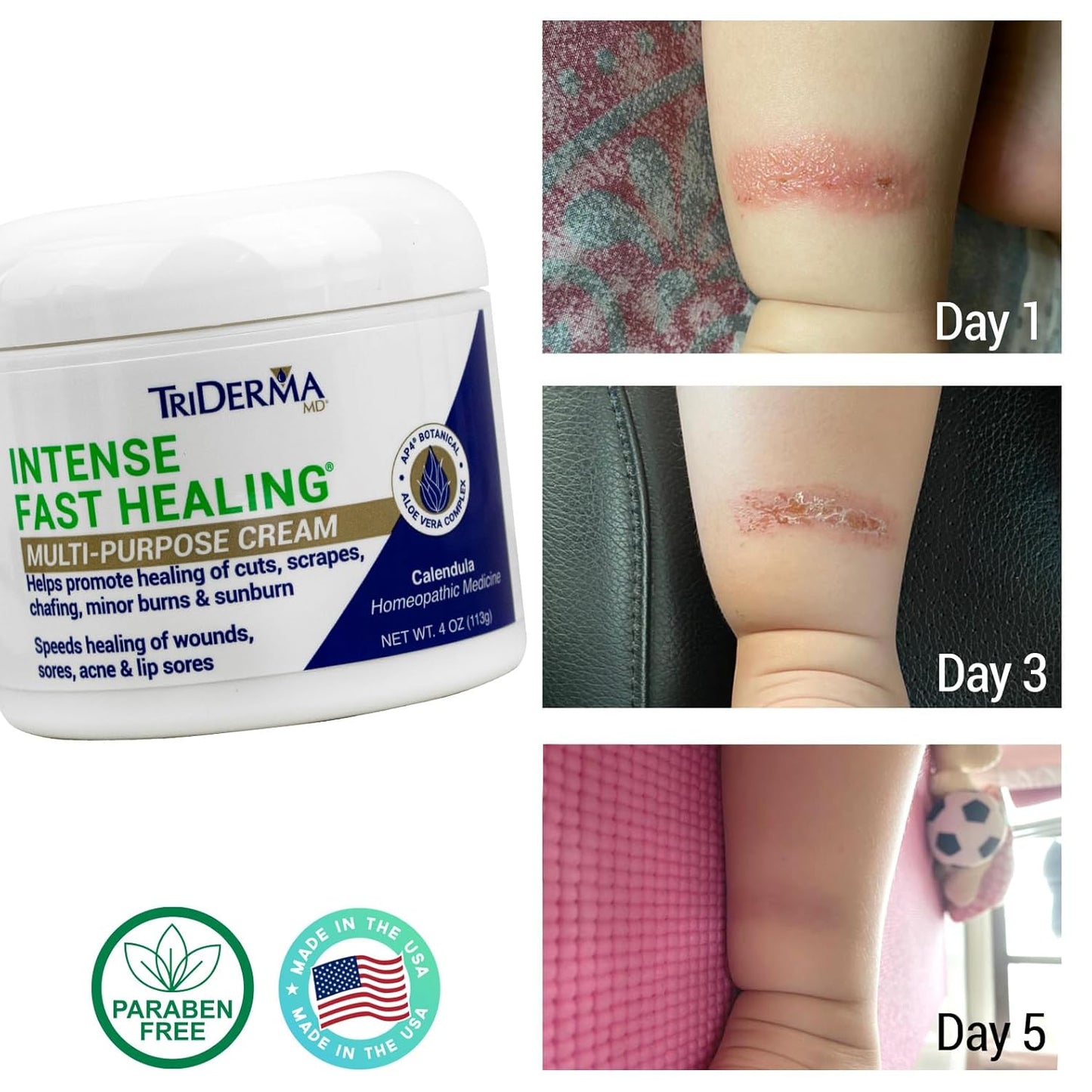 TriDerma Intense Fast Healing Cream, Decreases Healing Time for Minor Irritations, Rashes, Wounds, Cuts, Scrapes, Value Pack of 2-4 Ounce Jars