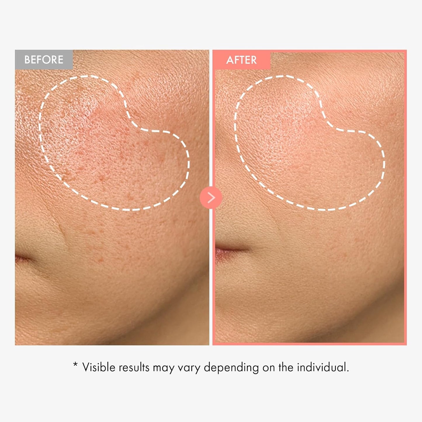 TOSOWOONG Peach 80 Niacin Serum, 5% Niacinamide, Alpha-Arbutin, Vitamin B12, Glass Skin, Hydrating Face Serum for Dark Spots, Pore Minimizer, Uneven Tone, Dullness, Korean Skincare, 33ml/1.11 fl. oz.