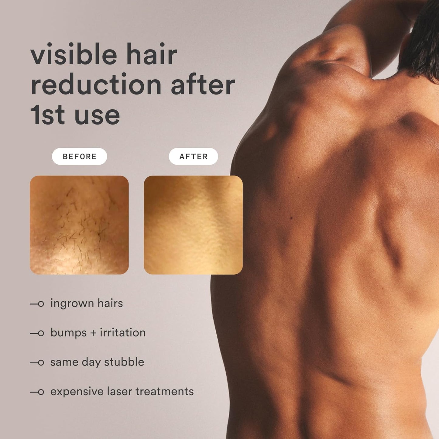 NEW Nood™ Flasher Pro — IPL Laser Hair Removal Device for Women & Men with Sapphire Cooling — Pain-free & Permanent, Visible Results After First Use & Works Everywhere Hair Grows — Matte Black