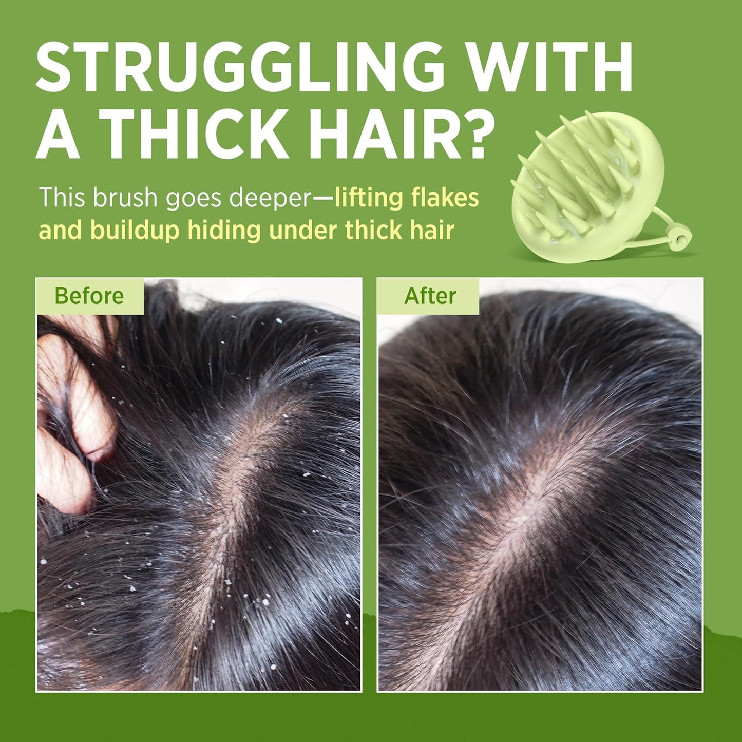 Roycederm Scalp Massager Brush Hair Scrubber – Soft Silicone Shampoo Brush for Scalp Care, Itchy Relief & Deep Cleansing – Ideal for Dandruff, Seborrheic Dermatitis & Scrub Use