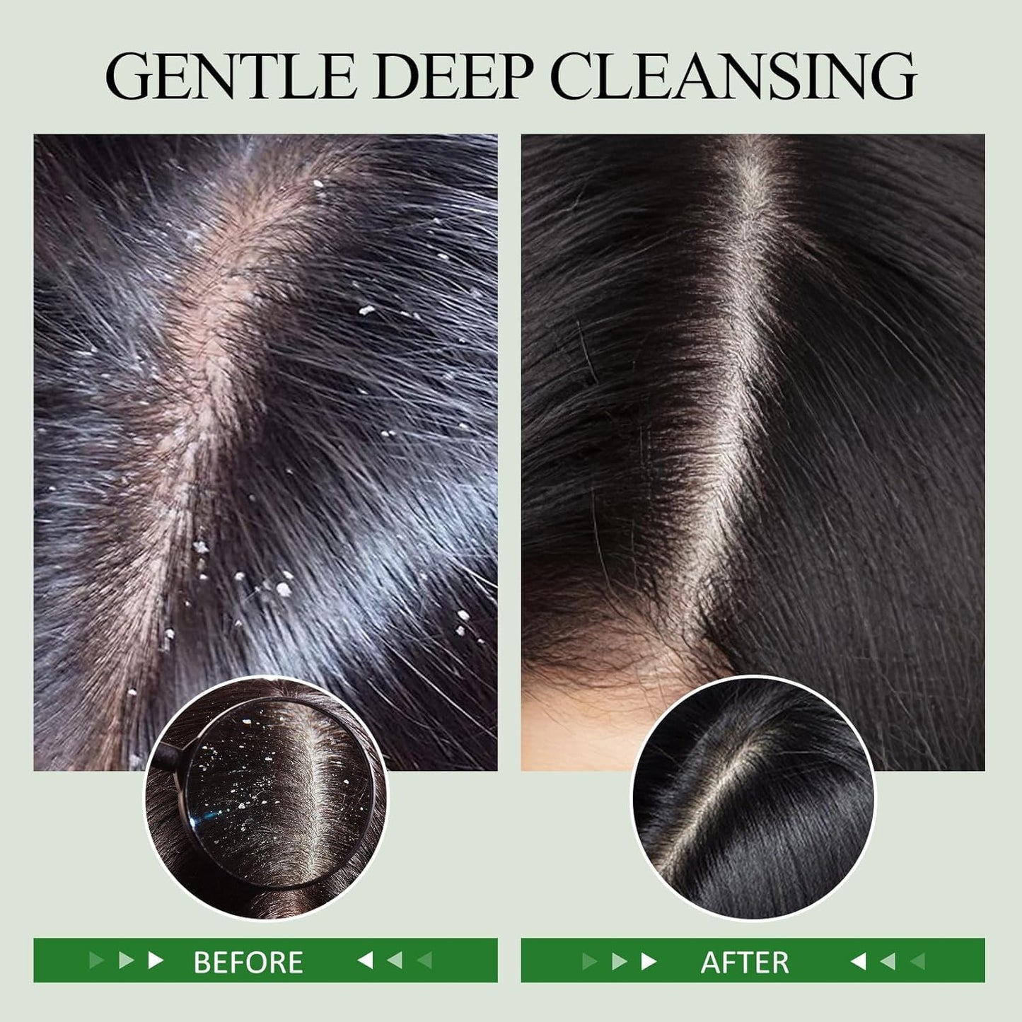 SHVYOG Scalp Scrub, Rosemary Scalp Exfoliator, Scalp Exfoliator Scrub for Build Up, Oily Hair, Hair Treatment Nourishing Detox Hair Care with Scalp Massager