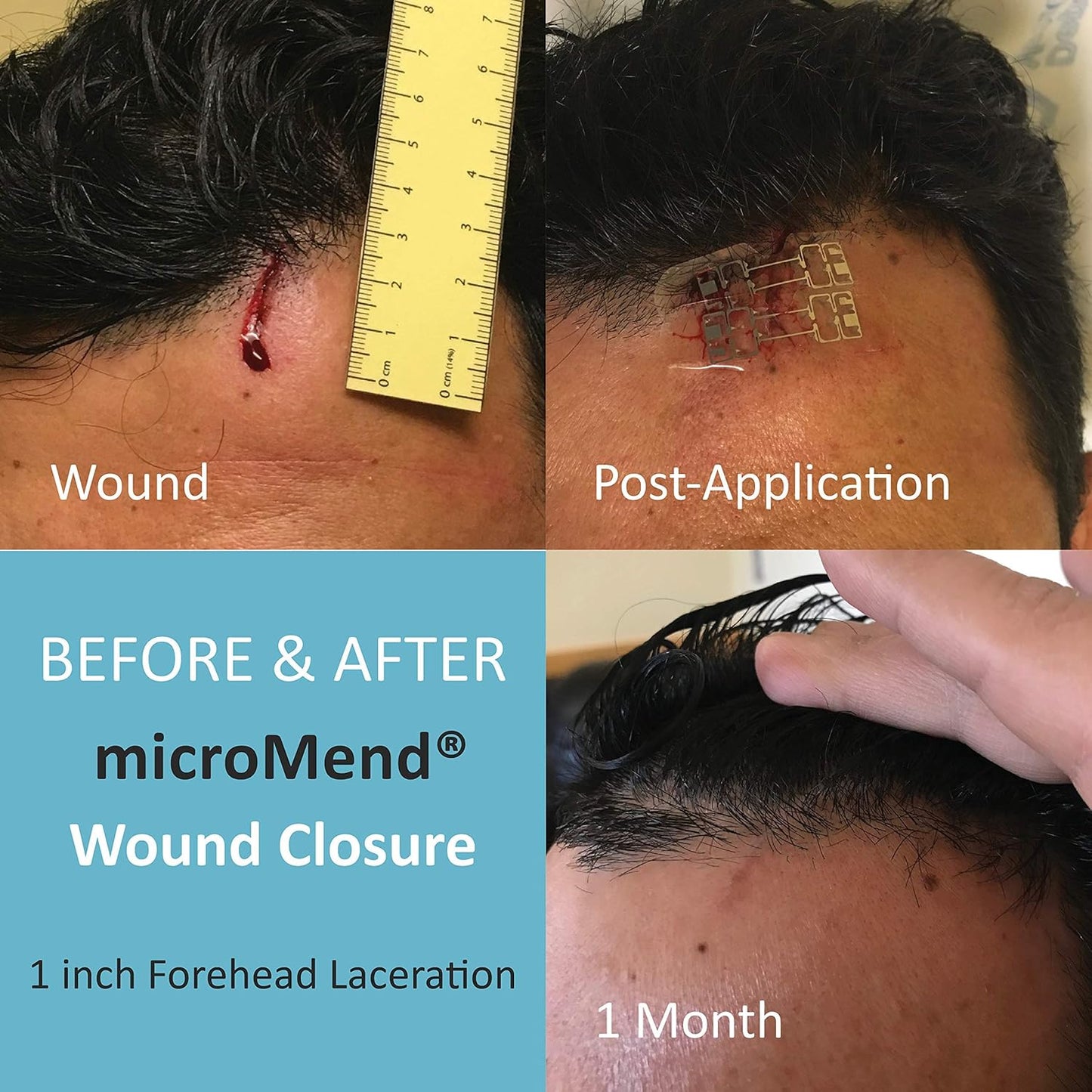 Emergency Wound Closures Surgical Quality Laceration Repair Without Stitches - Think Ahead - Be Prepared- (Emergency Wound Closures XS/SM (2 Devices - 1 Alcohol Prep Pad - 1 Gauze)